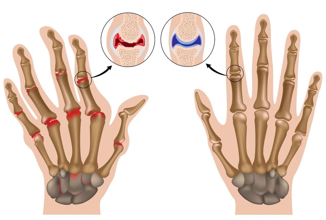 مفاصل اليد السليمة والمتضررة من التهاب المفاصل