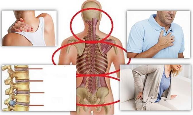 أماكن المرض لتصلب العظم
